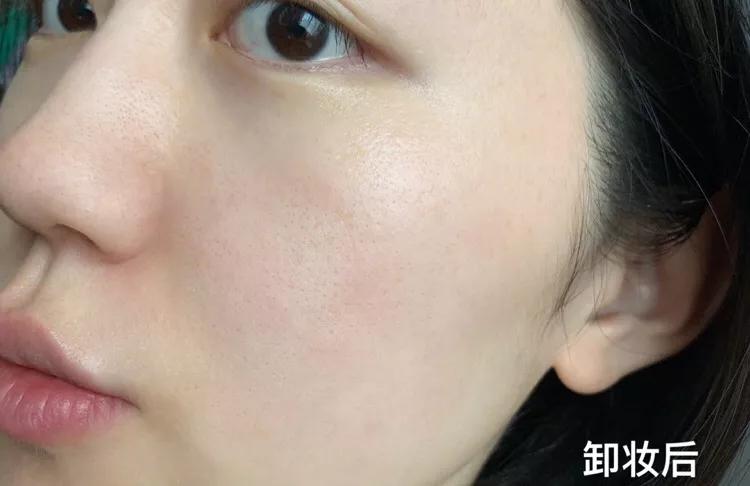 脸上长痘痘的原因和注意事项,脸上长痘痘到底应该怎么解决