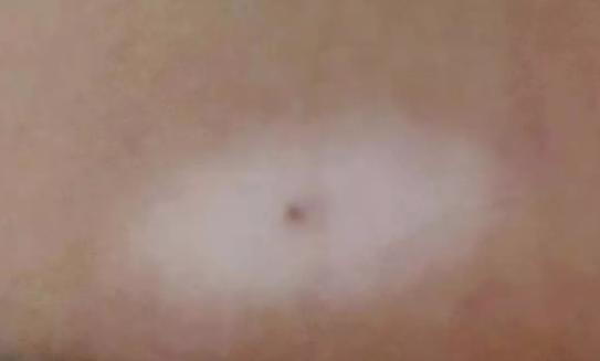 什么是晕痣和白癜风,晕痣型白癜风和白癜风有什么区别