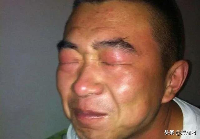 电焊打了眼什么方法最有效,电焊打了眼睛有什么特效药