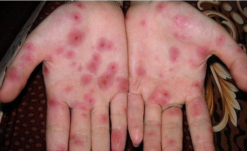 通过*生活性**传播的疾病：常见的有这5种，若想避免这3点或要注意