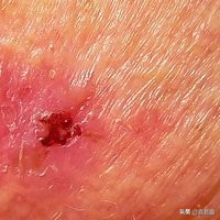 皮肤干燥脱皮10分钟清晨急救法,皮肤干燥尤其是秋冬会全身脱皮