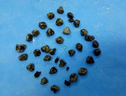 噩运总是接踵而至，当你贫血了之后你还会有胆结石，这是必然的