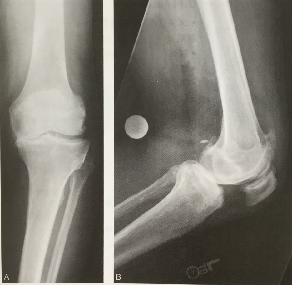 膝关节有骨刺可以手术磨掉吗,膝盖有骨刺增生多久能恢复健康