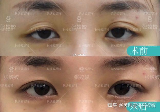 眼皮松弛双眼皮变成单眼皮怎么办,眼皮松弛割单眼皮全切双眼皮过程