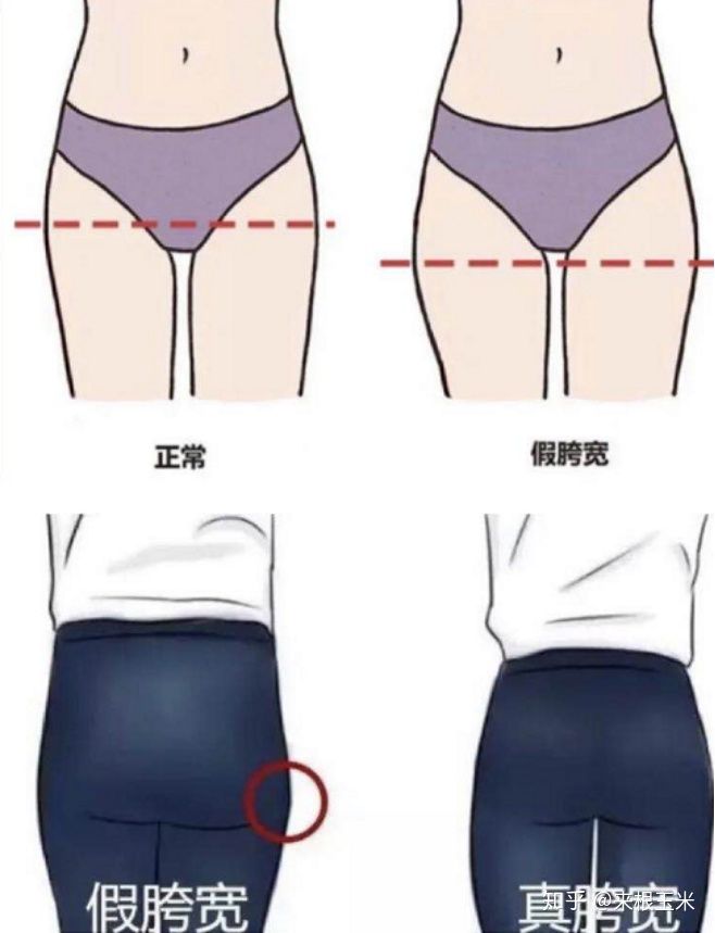 水肿腿加大象腿怎么瘦,大象腿赘肉多