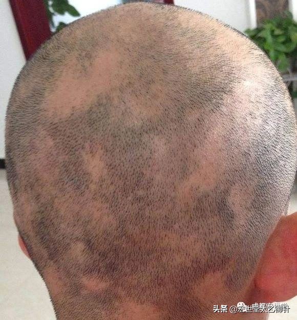 斑秃快秃了怎么办,斑秃秃顶头发能恢复吗