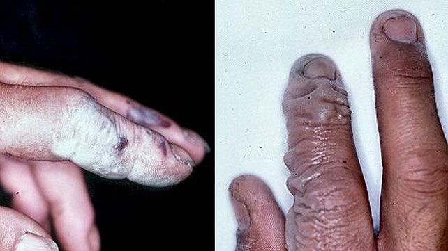 化学品灼伤案例,触目惊心的各种突发安全事故