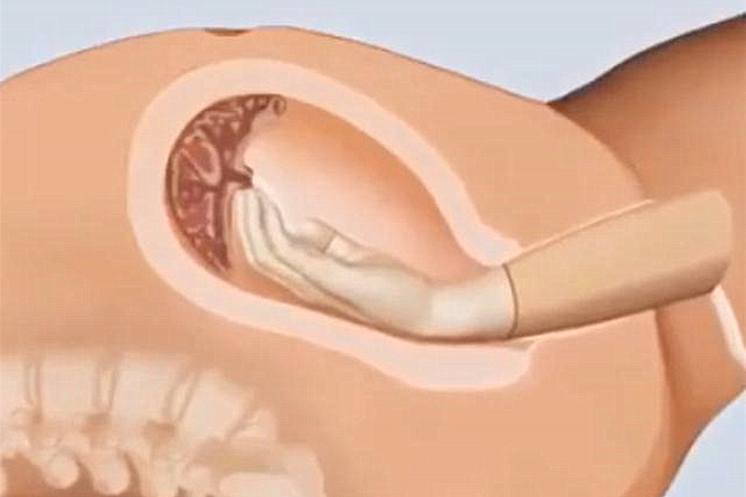 生完孩子医生又把手伸进去,产妇愤怒质问,医生沉稳回答:为你好