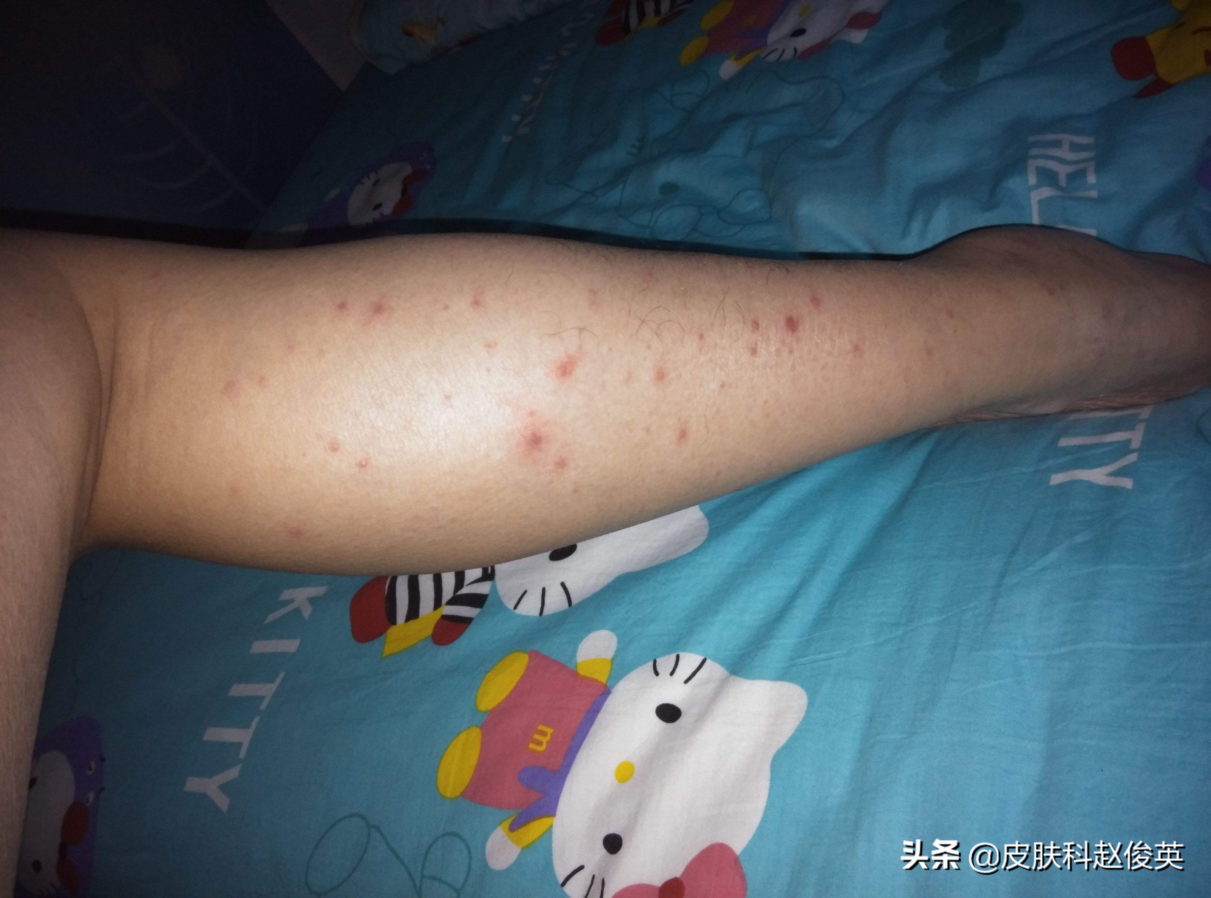 虫咬住了怎么办,被虫咬后出现什么症状要注意