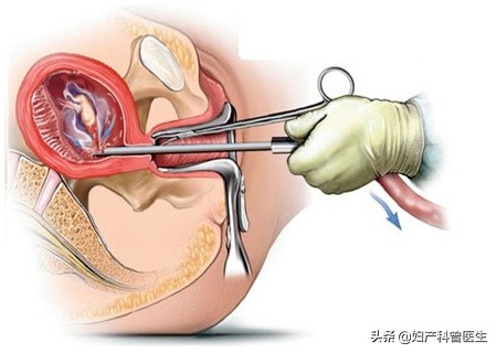 无痛人流会有哪些风险跟后遗症,无痛人流真实经历感受