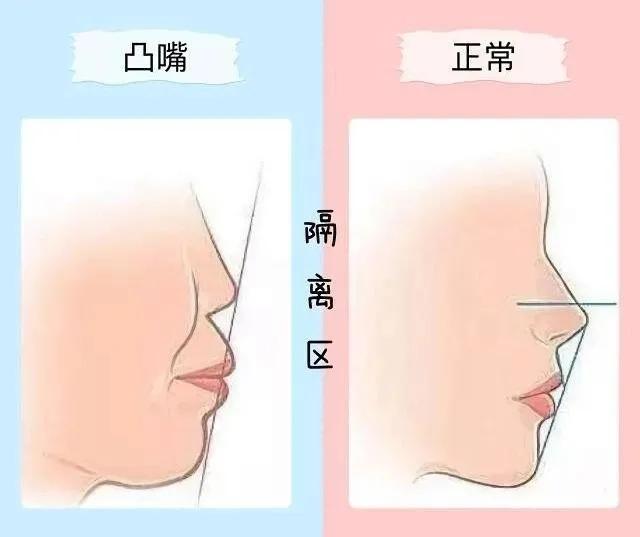 哪些小动作可以改善凸嘴,改善凸嘴的十大方法