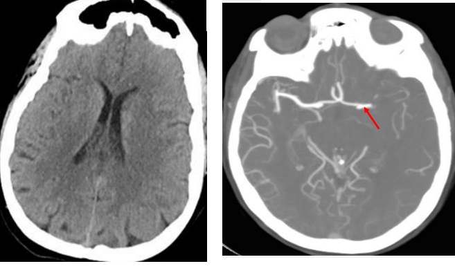 大脑动脉闭塞脑梗死怎么引起的,脑梗死的血管闭塞怎么治疗