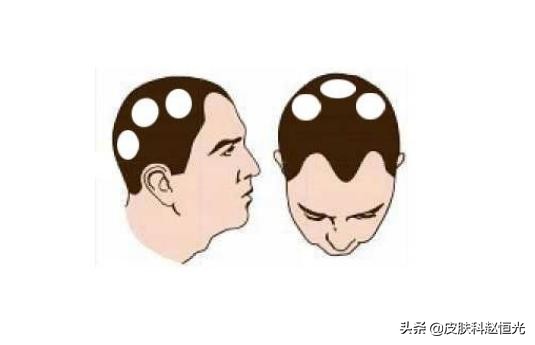 脱发无法治疗后的日常护理,脱发无法挽救