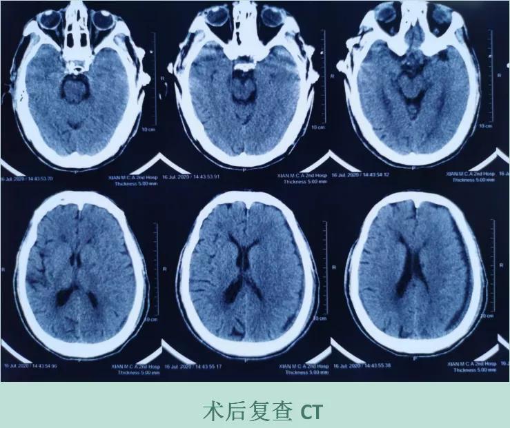 摔跤后有脑血肿怎么处理,轻微摔伤怎么处理