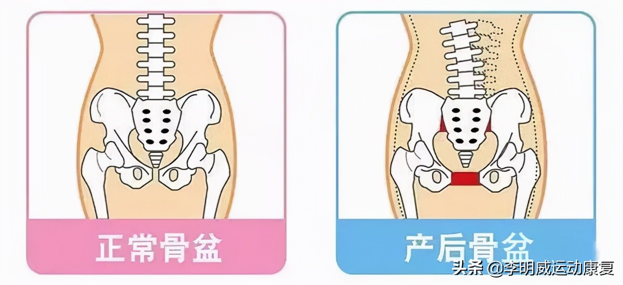 骨盆前倾骨盆不正怎么恢复,骨盆不正会造成什么后果