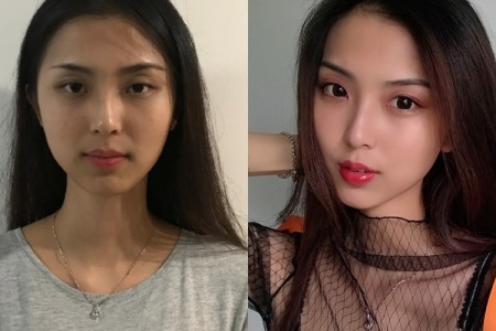 提升脸部下垂做什么项目好,皮肤下垂怎么办可以做面部提升吗