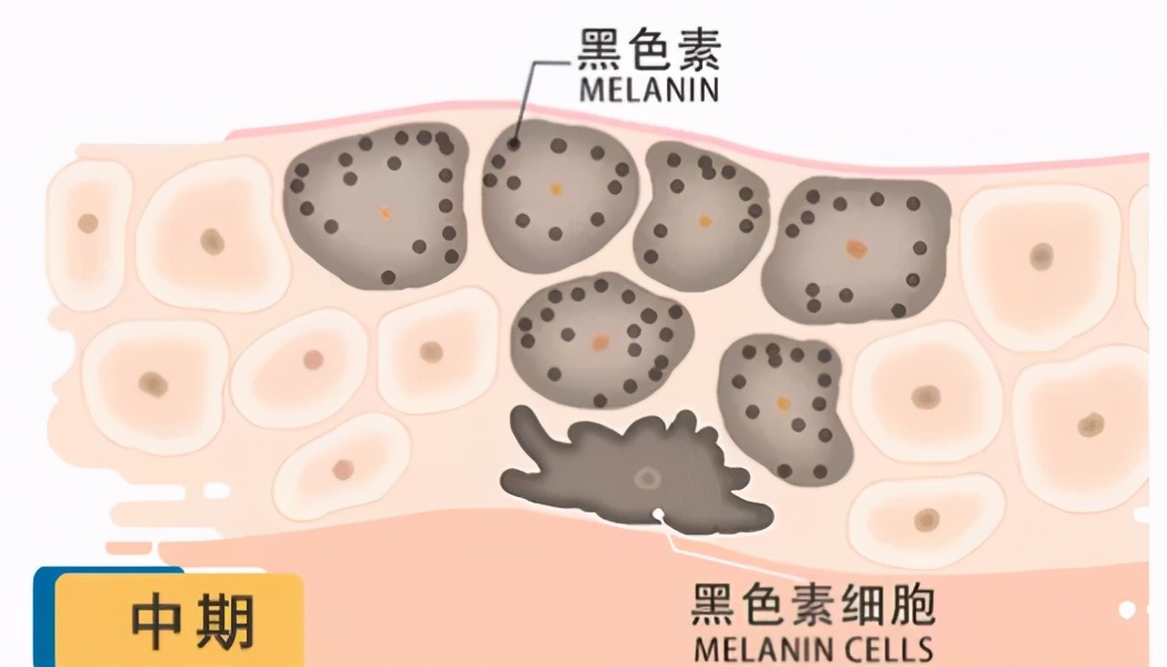 什么样的斑适合激光祛斑,青褐斑可以用激光吗