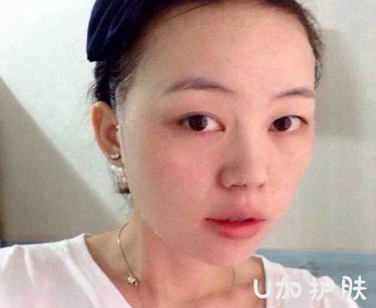 长痘怎么办如何拯救痘痘肌肤,脸上长痘痘怎么调理6招痘消失