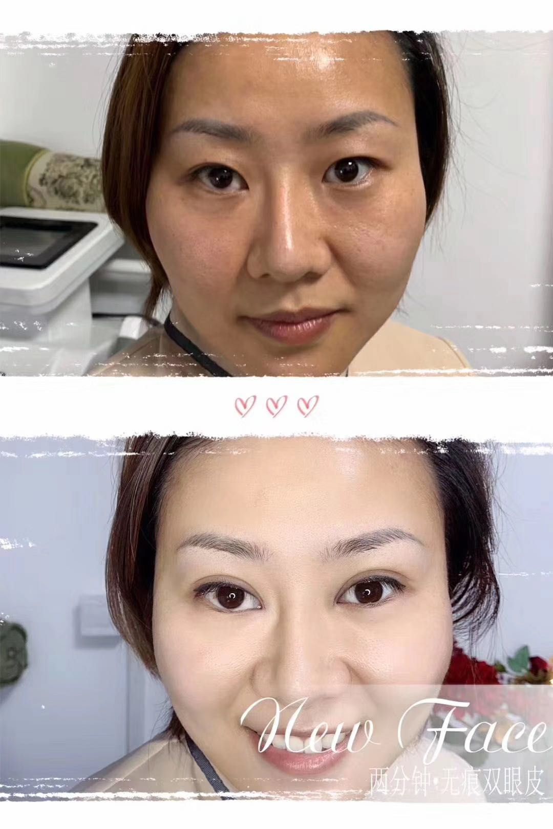 双眼皮手术睁眼闭眼效果,双眼皮手术怎么看着不假