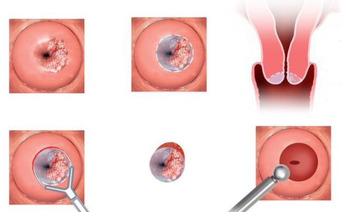 得了宫颈癌前兆怎么治疗,宫颈癌或子宫癌的早期信号