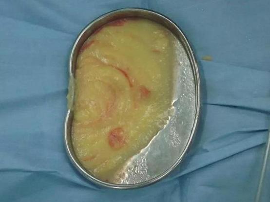 “发黄母乳”哺乳婴儿三个月，致使宝宝脑瘫！竟然是隆胸惹的祸