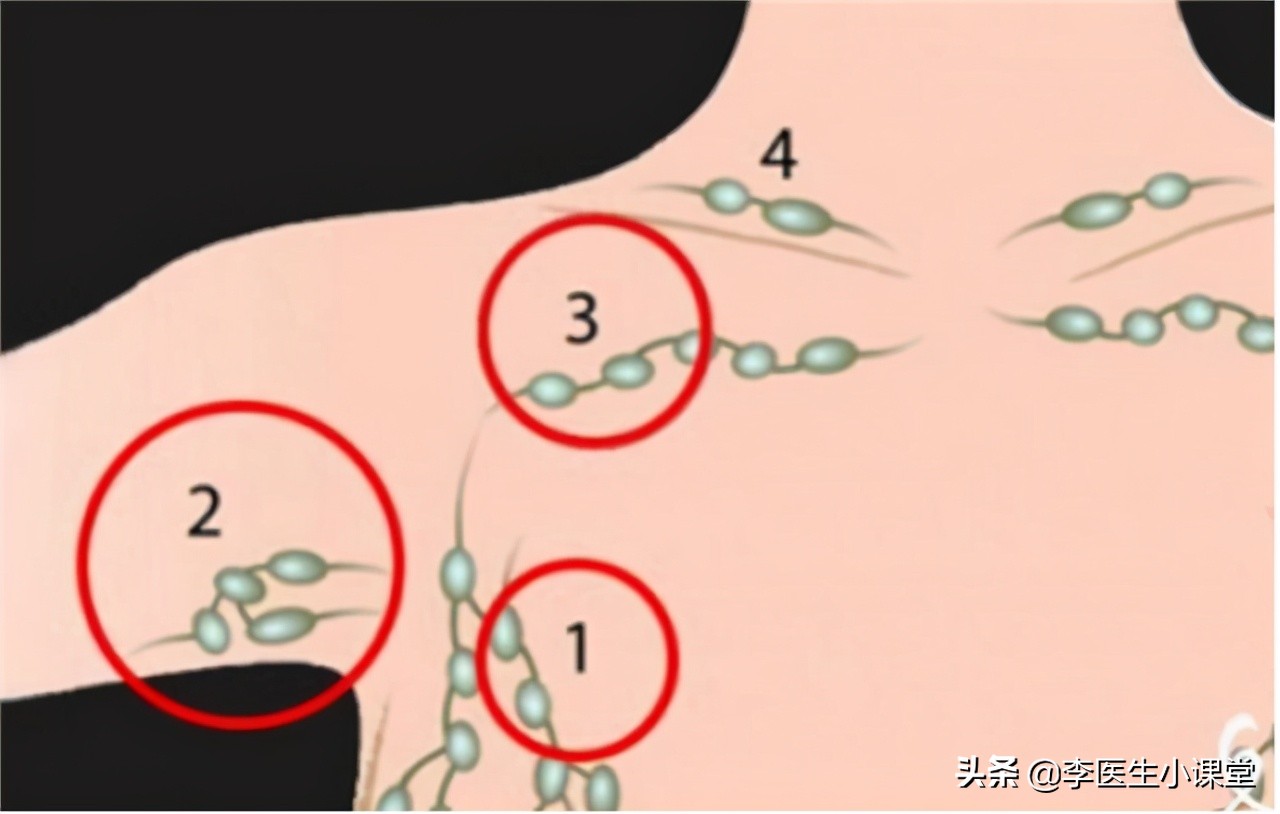 感染引起的淋巴结肿大怎么办,感染引起的恶性肿瘤