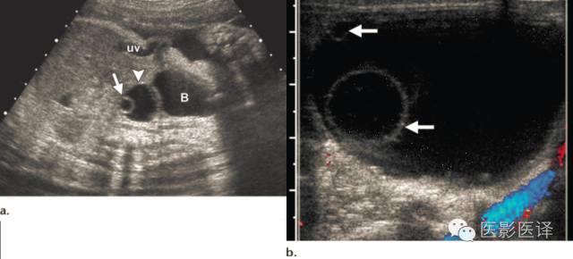 孕期发现卵巢囊肿有8cm左右,孕19周查出胎儿卵巢囊肿