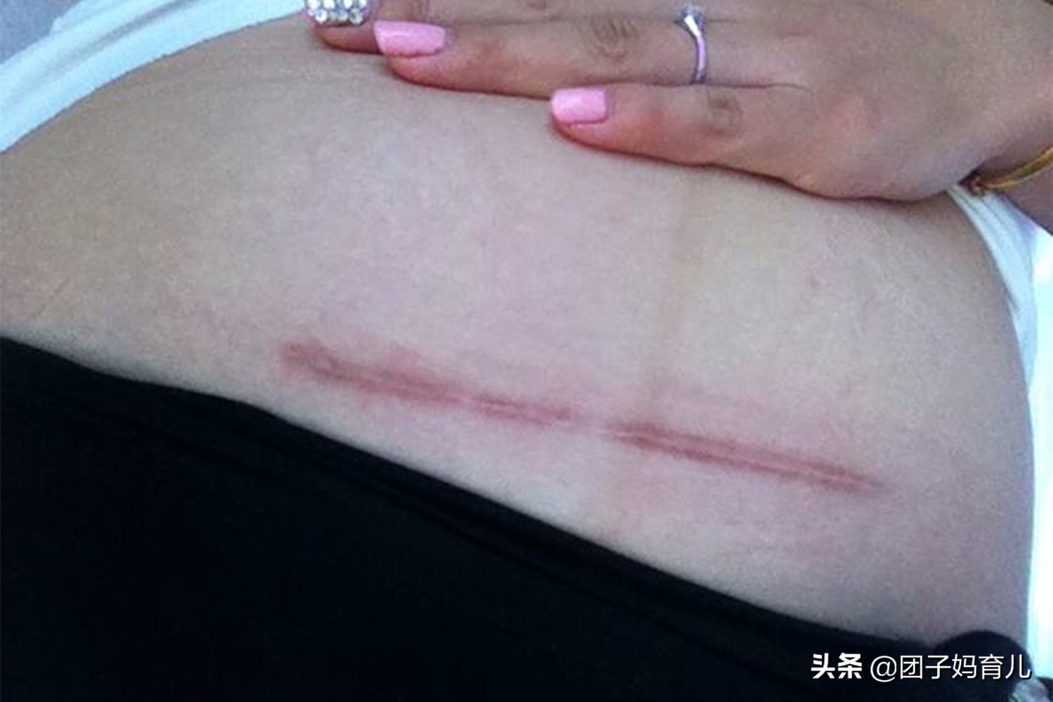 剖腹产生娃也能改善体质吗,剖腹产半麻醉生孩子的真实流程