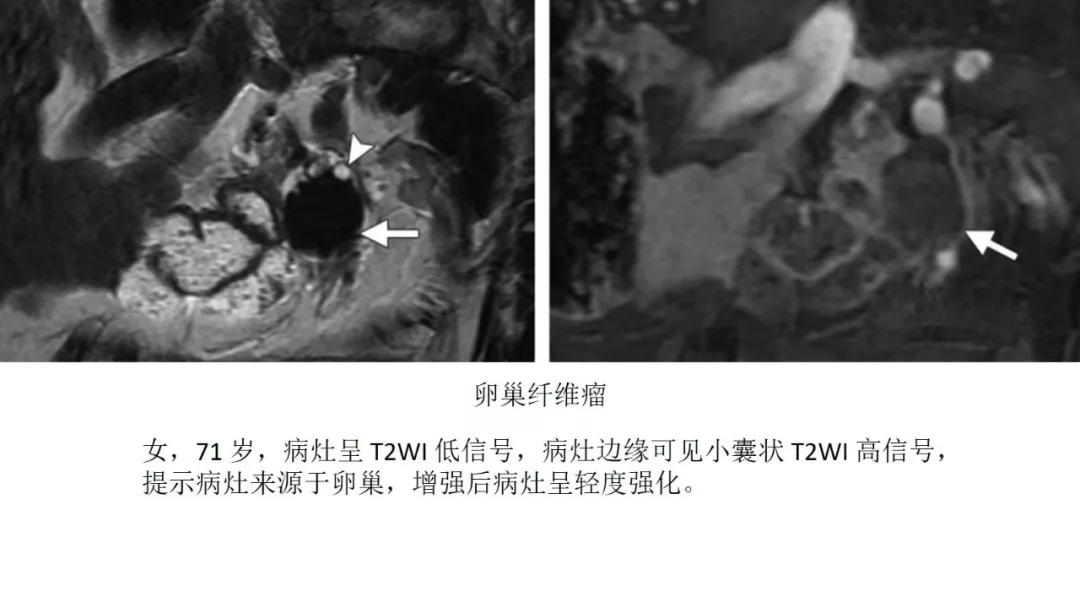 卵巢原发肿瘤的分析思路