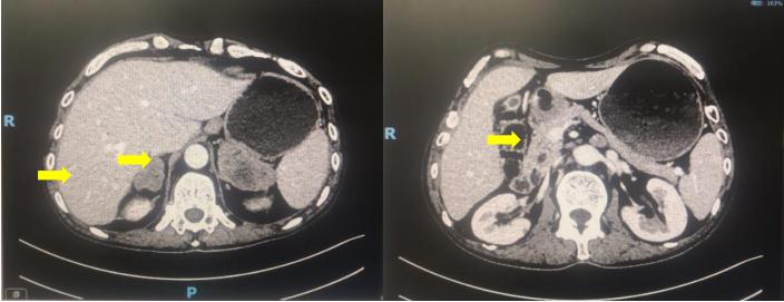 六旬男子小肠癌晚期，经化疗联合免疫治疗后疾病获得长期缓解。免疫治疗或将成为肠癌重要的治疗手段
