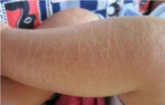 宝宝皮肤上有鱼鳞状,刚出生的宝宝长了鱼鳞病