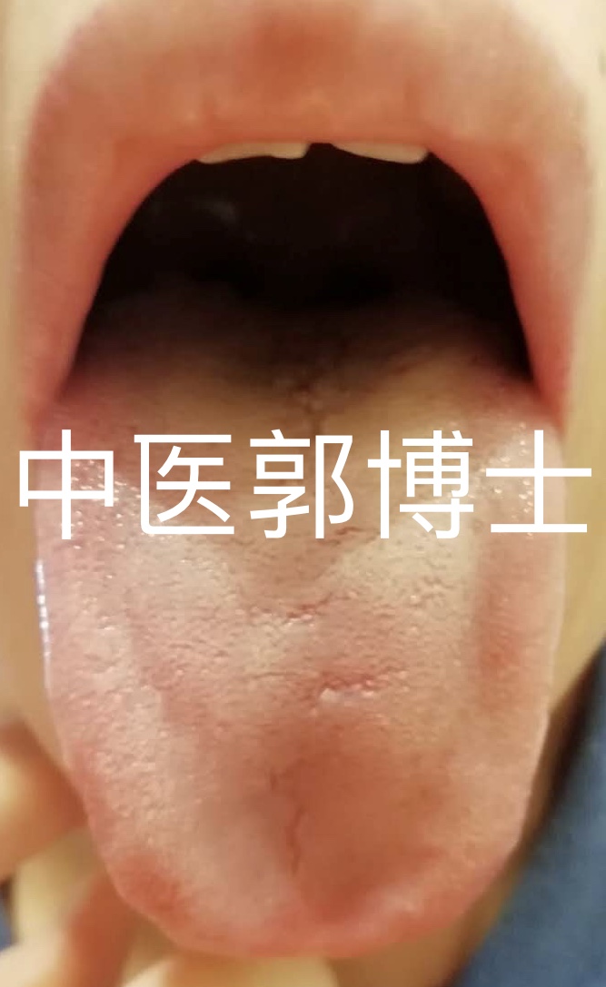 舌头干舌燥吃什么药最有效,舌干舌燥喝水也不管用怎么解决