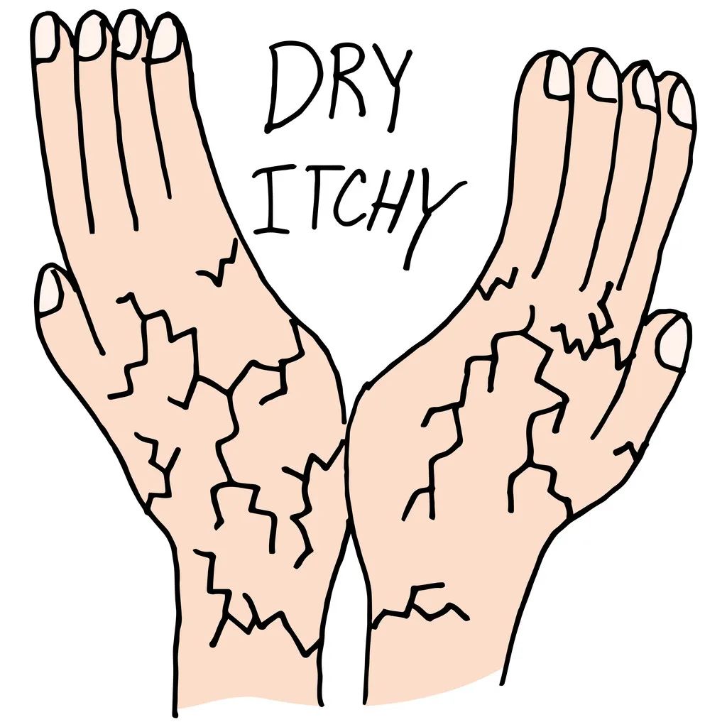 手上有脚气起小水泡痒还干裂,脚气痒脱皮会传染到手肘吗