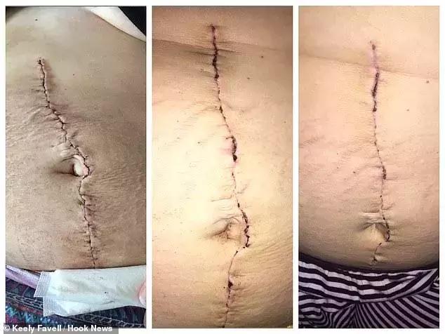 论体检的重要性英国女子长26公斤囊肿被疑怀孕