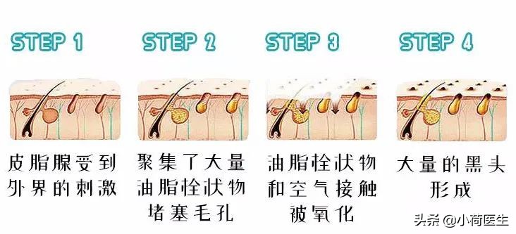 顽固的黑头用祛黑头仪真的能行吗,黑头的成因以及祛黑头的方法