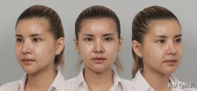 18岁土肥圆豪掷800万全身整形，鼻子6次大整假体穿出，效果却超美