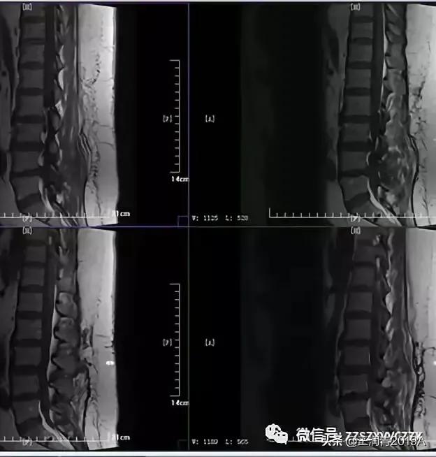 弯腰捡东西，腰痛腿麻大小便*禁失**，竞是腰椎间盘髓核脱出惹的祸