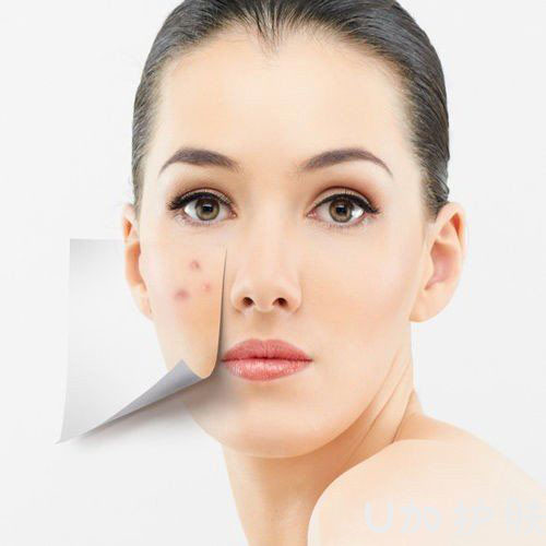 长痘怎么办如何拯救痘痘肌肤,脸上长痘痘怎么调理6招痘消失