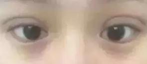 男生割内双眼皮手术,男子去割单眼皮后的结果