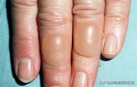 艾灸后出现水泡需要扎破吗,艾灸后起的水泡是排湿还是烫伤