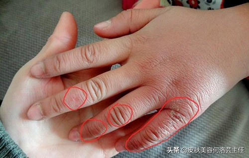 冬天冻疮又痛又痒用什么药喷最好,冻疮又疼又痒怎么缓解