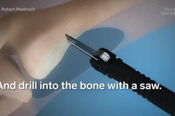 手术的时候医生对你做了什么,手术时切了一片肺叶