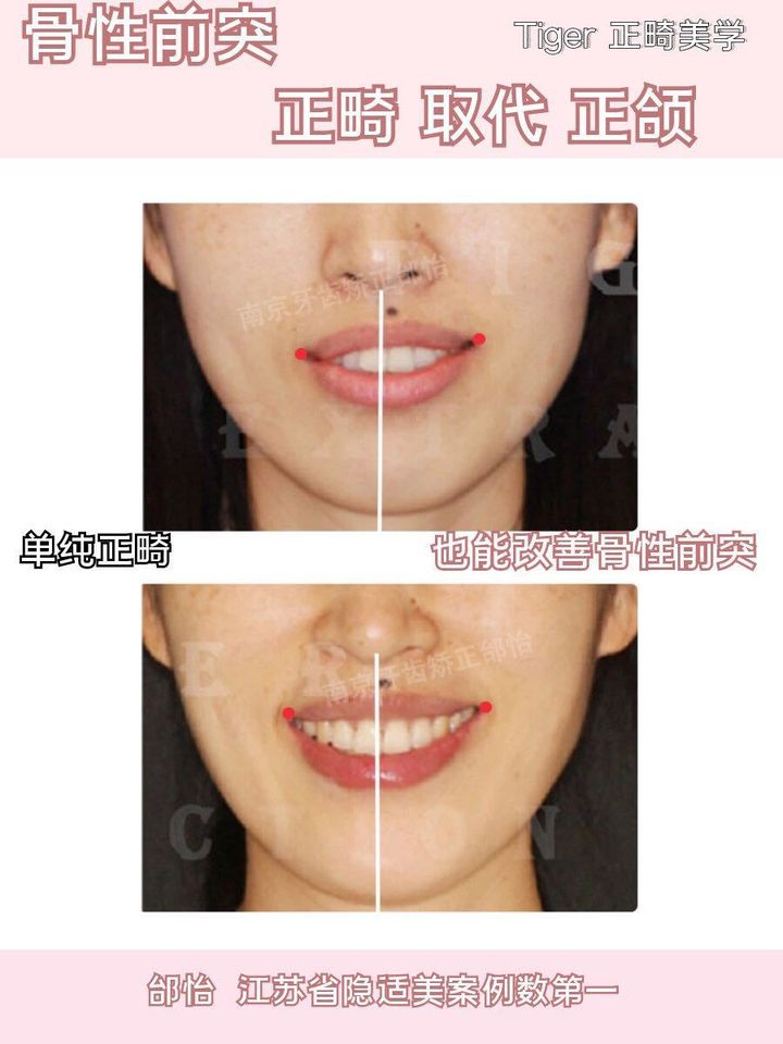 隐适美矫正危害,隐适美矫正真实案例