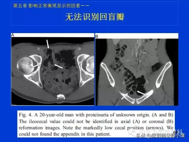 阑尾炎课件,阑尾炎的超声课件