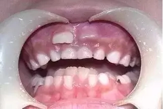 面对金口难开的家长该怎么沟通,青少年长双排牙怎么处理