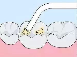 12岁前必须矫正的儿童牙颌畸形,孩子的牙错颌畸形还能矫正过来吗