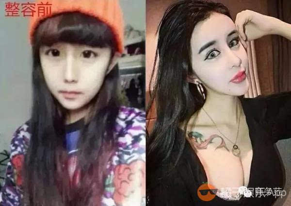 网红玻尿酸,为什么网红都打玻尿酸