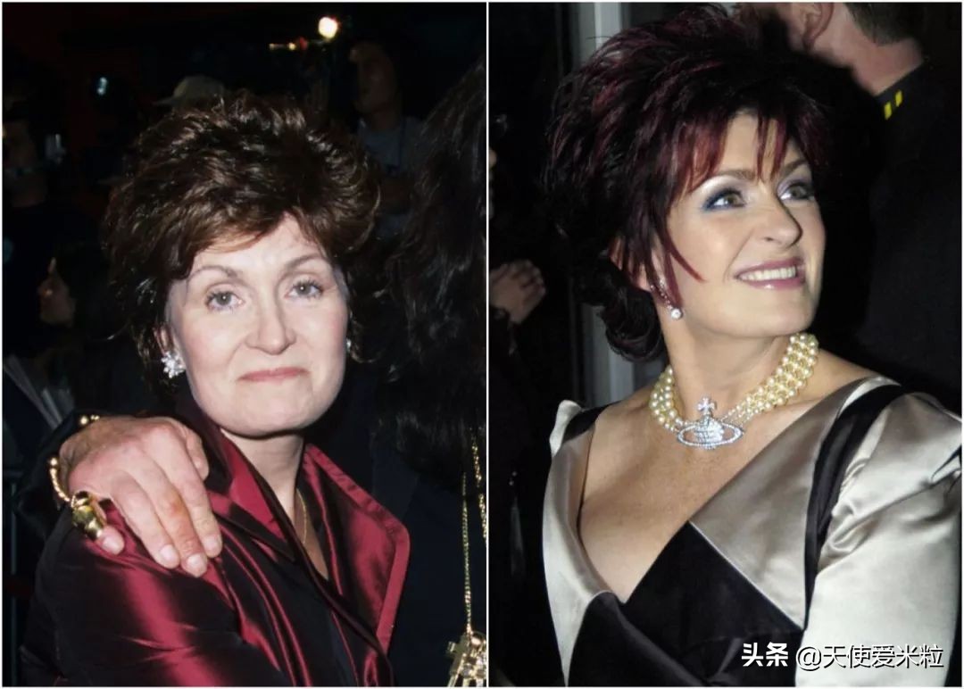 做了拉皮手术第九天疼,68岁女人拉皮手术后续