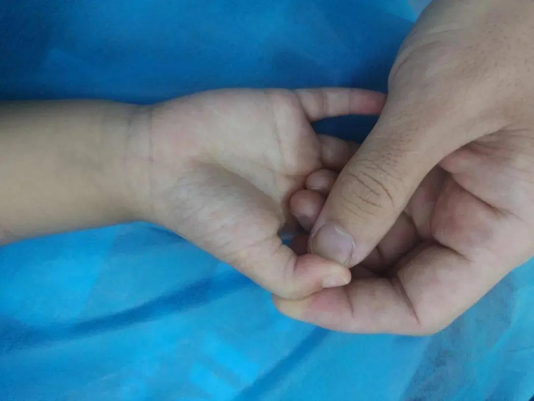 先天性腱鞘炎宝宝小拇指伸不直,小儿手指腱鞘炎不治疗的严重后果