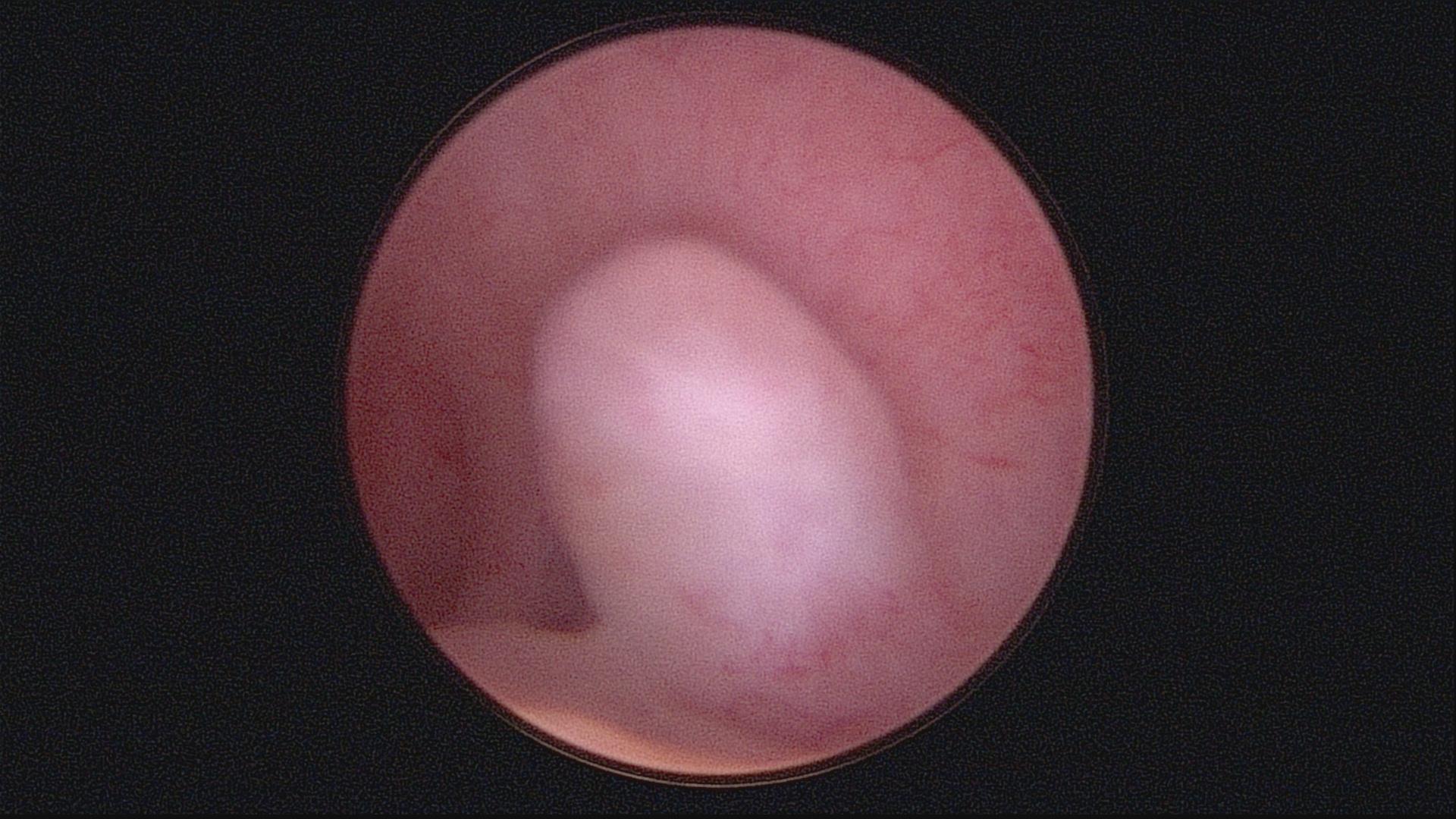 安徽宫腔镜手术专家排名,安徽省立宫腔镜哪个医生做的好